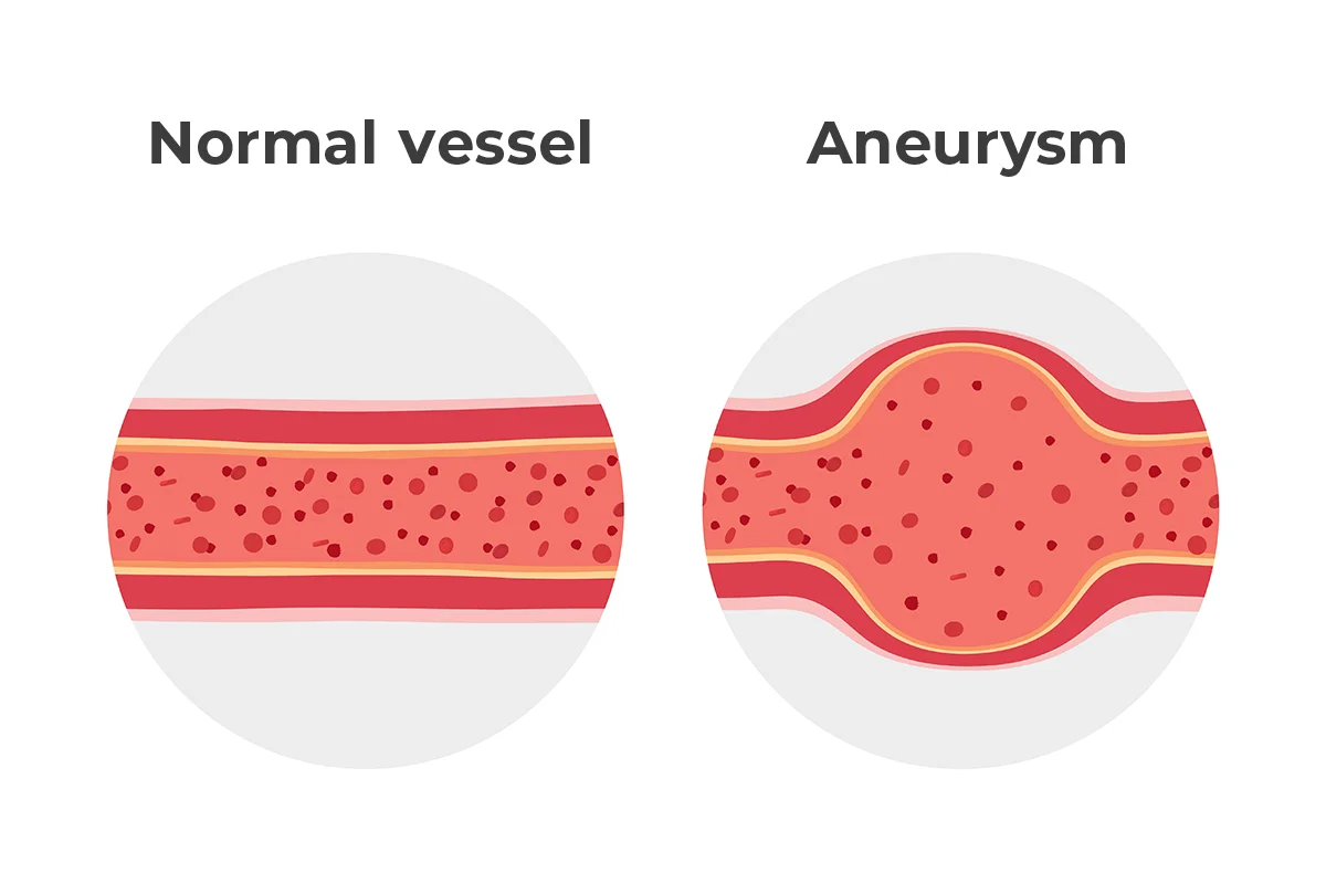 Image shows a healthy artery and an artery with a bulging aneurysm. 