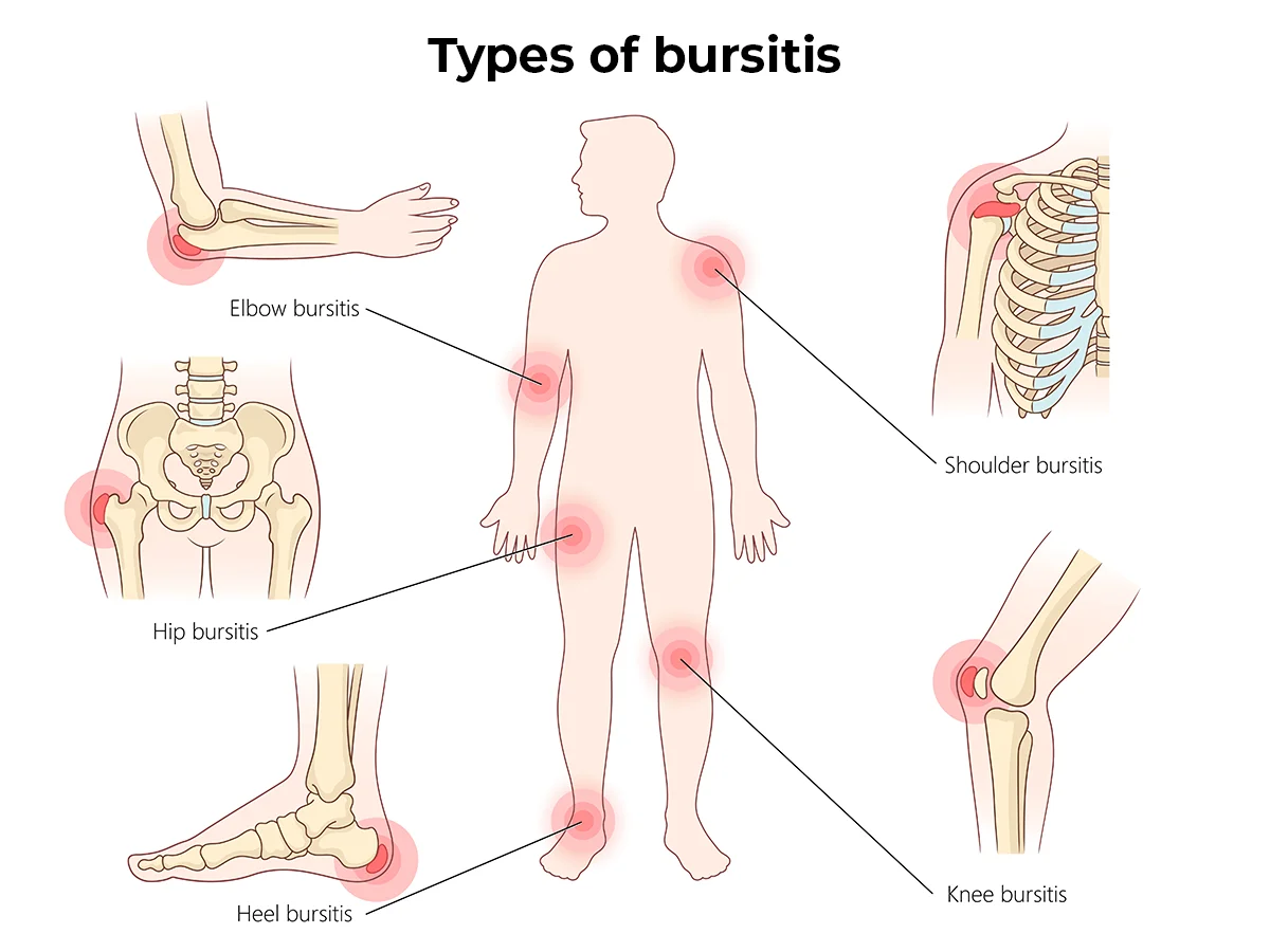Image shows common locations afflicted by bursitis. 