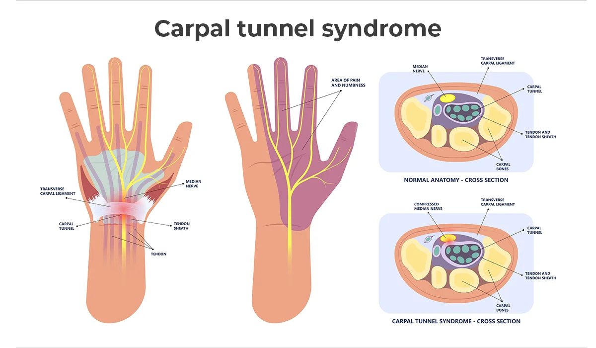 Image shows normal anatomy of a hand with and without carpal tunnel syndrome.
