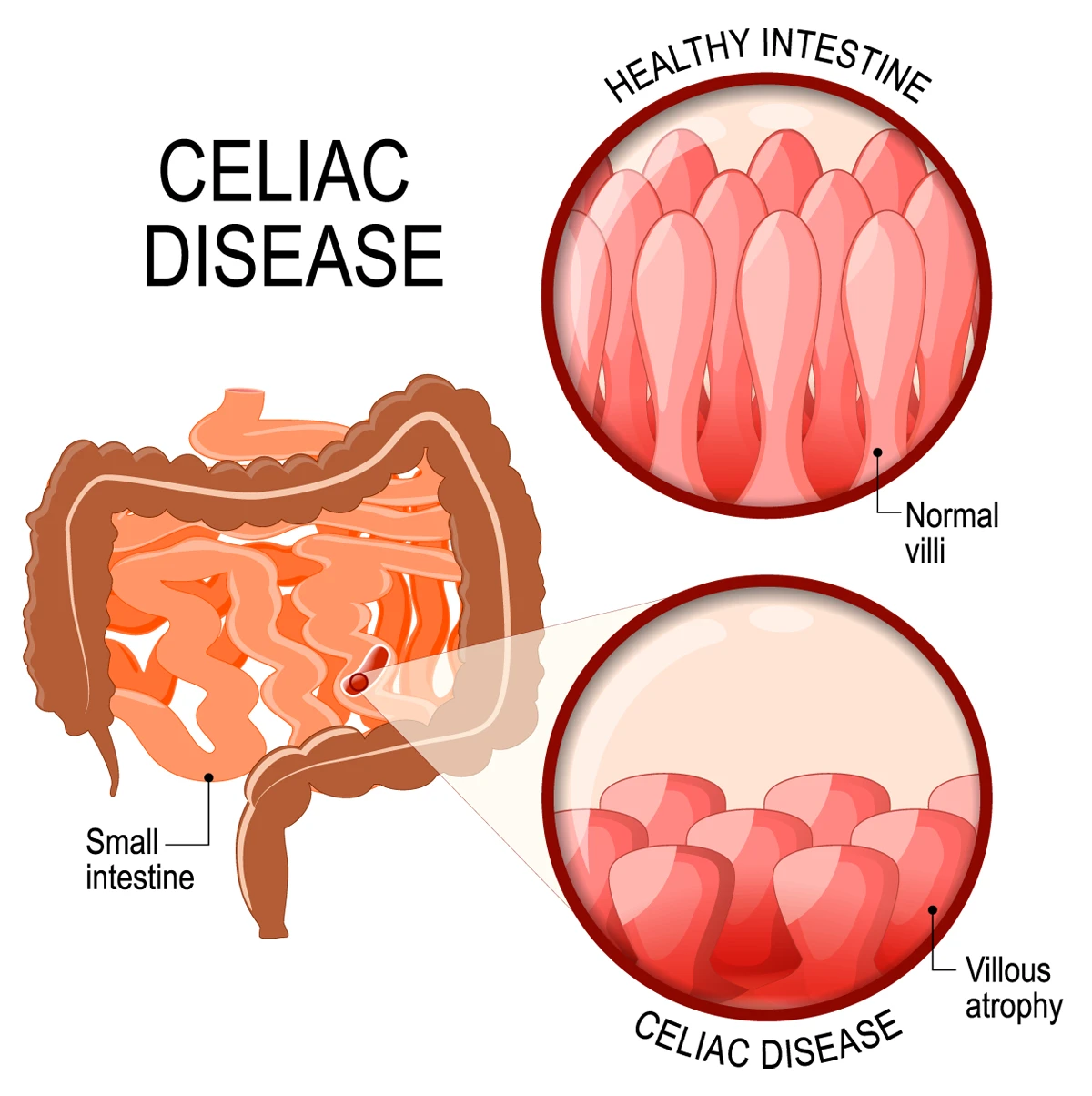  Image shows normal intestinal lining and that with Celiac disease. 