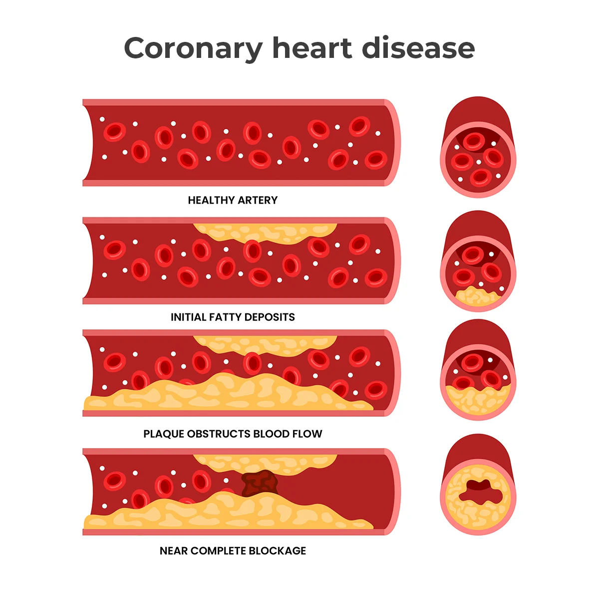  Image shows the progression from a healthy artery to an artery that’s blocked by plaque.