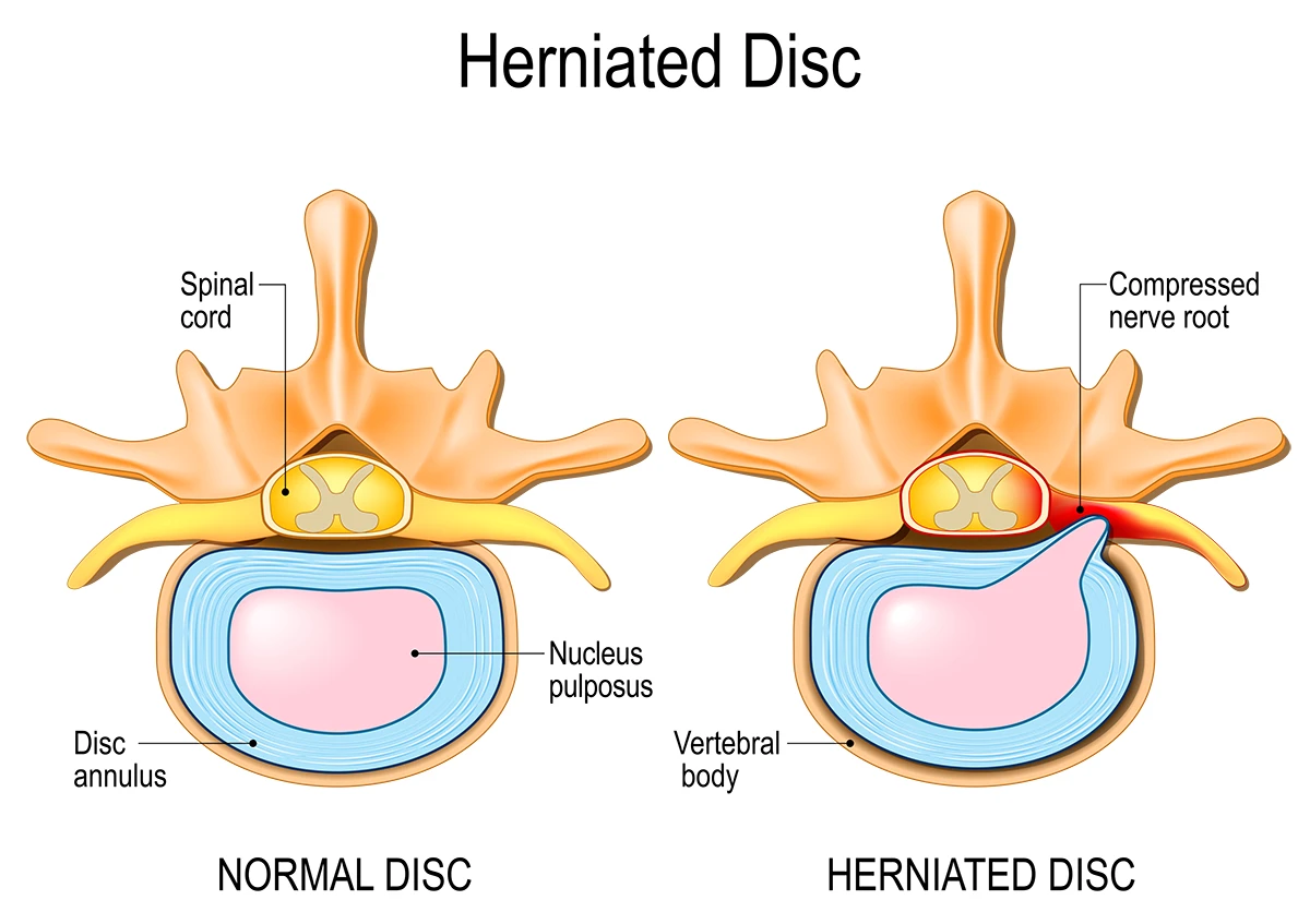 Image shows the difference between the inside of a normal disc on the right and a spine with a herniated disc.