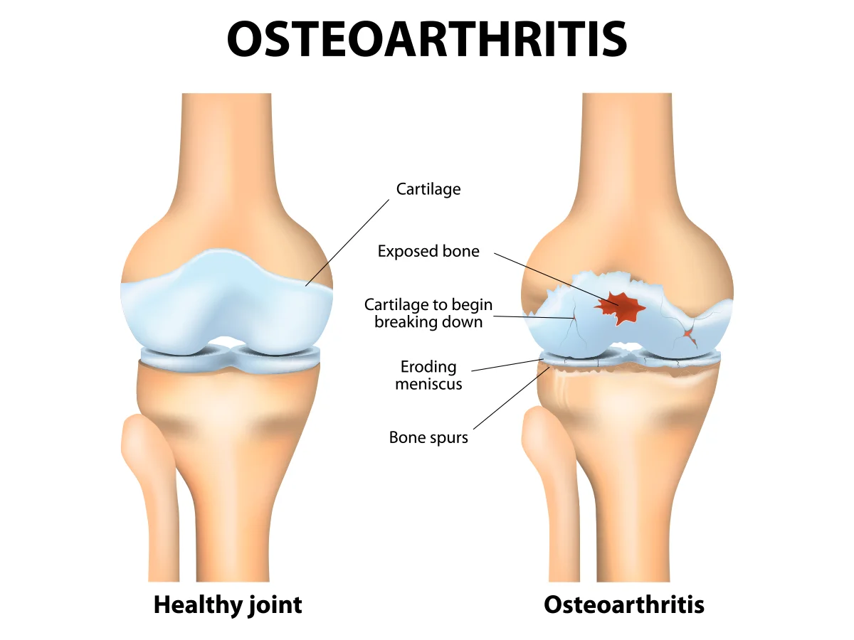 Osteoarthritis, also known as degenerative joint disease, happens when the cartilage in your joint breaks down and causes the connecting bones to rub against each other, causing pain and inflammation.