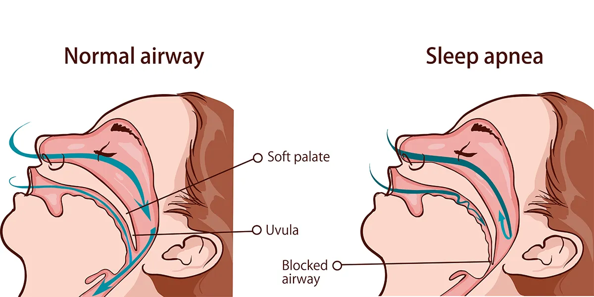 An illustration of the airflow for a person with a normal airway versus a person with a sleep apnea-affected airway.